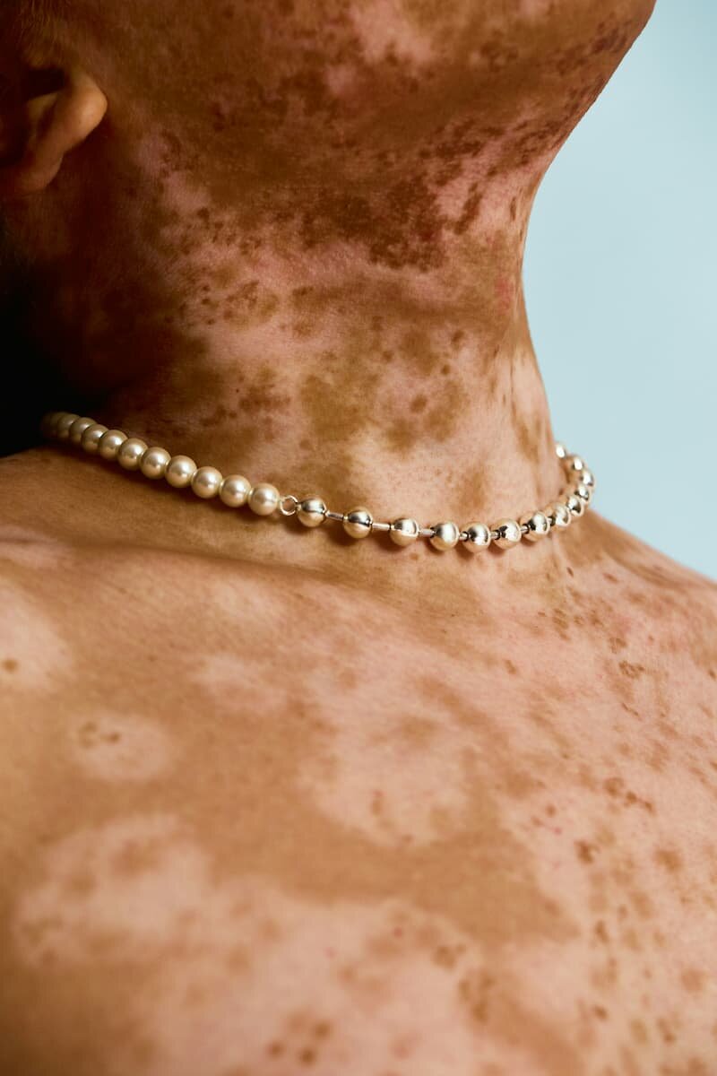 Webinar zum Welt-Vitiligo-Tag