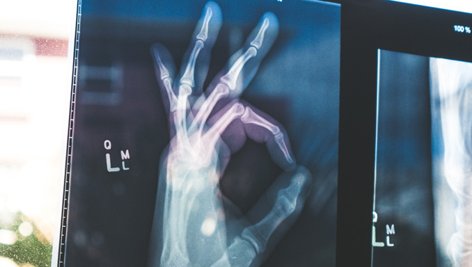 Hat man mit Psoriasis arthritis eine geringere Lebenserwartung?