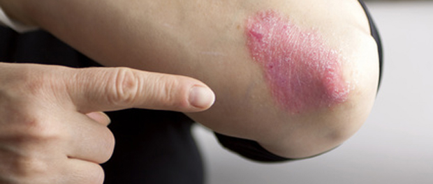 Psoriasis vulgaris – die häufigste Form der Schuppenflechte