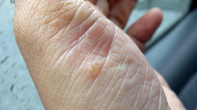 Psoriasis pustulosa