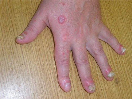 Nagelpsoriasis