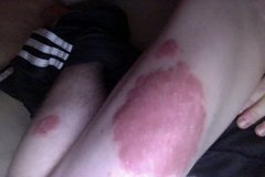 Psoriasis an den Beinen