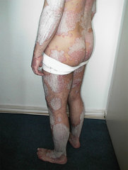 Extrem dicke Borke