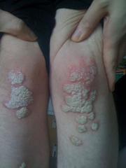 meine knie