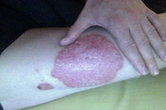 Psoriasis-Stelle am Bein – Größenvergleich