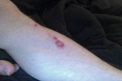 Kleine Psoriasis-Stellen am Bein