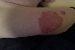 Psoriasis-Stellen am Arm