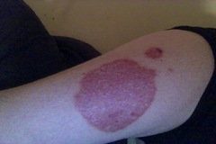 Große und kleine Psoriasis-Stelle