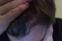 Psoriasis am Haaransatz