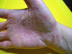 Psoriasis an der Hand