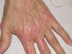 Schuppenflechte auf der Hand