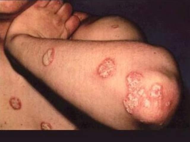 Schuppenflechte am Bauch, am Arm und an den Ellenbogen