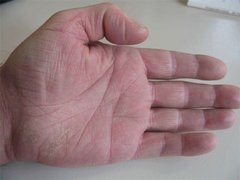 Therapie mit Interferenzstrom