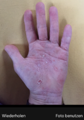 My Psoriasis App