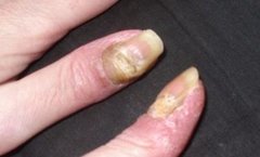 Nagelpsoriasis