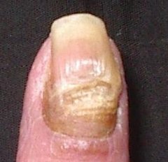 Nagelpsoriasis