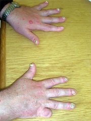 Nagelpsoriasis