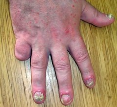 Nagelpsoriasis an mehreren Nägeln einer Hand