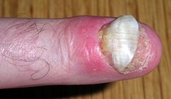 Nagelpsoriasis