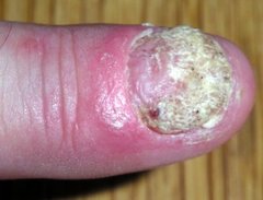 Ein schwerer Fall von Nagelpsoriasis
