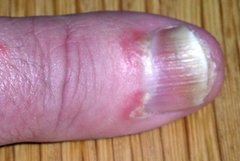Nagelpsoriasis am kurz geschnittenen Fingernagel