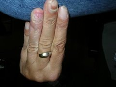 Nagelpsoriasis an der Hand