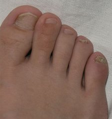 Nagelpsoriasis an den Zehen