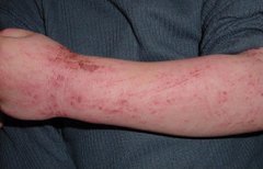 Neurodermitis am Arm
