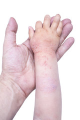 Neurodermitis an der Hand