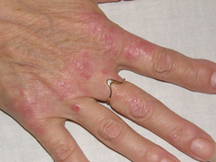 Psoriasis an der Hand
