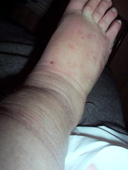 Psoriasis arthritis am Fuß