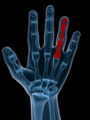 Psoriasis arthritis – Daktylitis (mutilans)