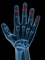 Psoriasis arthritis – Distaler Typ (DIP)