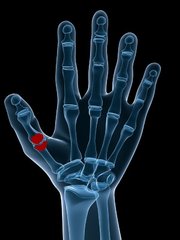 Psoriasis arthritis – Oligoatikulärer Typ