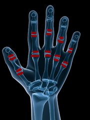 Psoriasis arthritis – Polyartikulärer Typ
