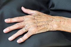 Psoriasis arthritis an der Hand