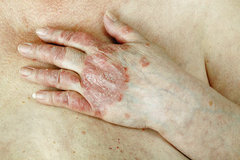 Hand mit Schuppenflechte und Psoriasis arthritis