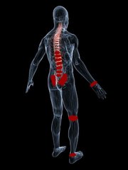 Psoriasis arthritis – Spinaler Typ