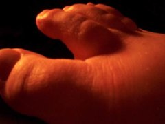 Psoriasis arthritis...