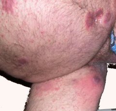 Psoriasis im Genitalbereich