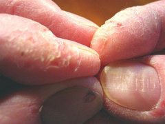Schuppenflechte an den Fingerkuppen (vorher)