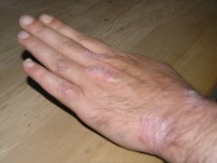 Psoriasis an der Hand