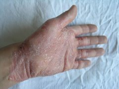 Psoriasis vulgaris palmoplantaris