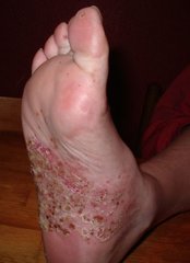 Psoriasis pustulosa am Fuß