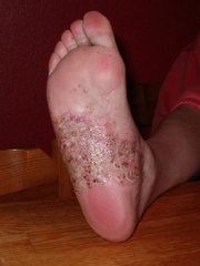 Psoriasis pustulosa am Fuß
