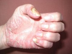 Psoriasis pustulosa an der Hand