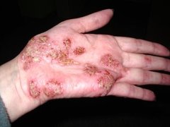 Psoriasis pustulosa an der Handinnenfläche