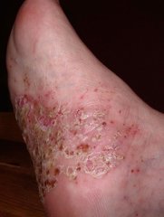 Psoriasis pustulosa am Fuß
