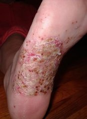 Psoriasis pustulosa an der Fußsohle