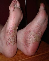 Psoriasis pustulosa an den Füßen